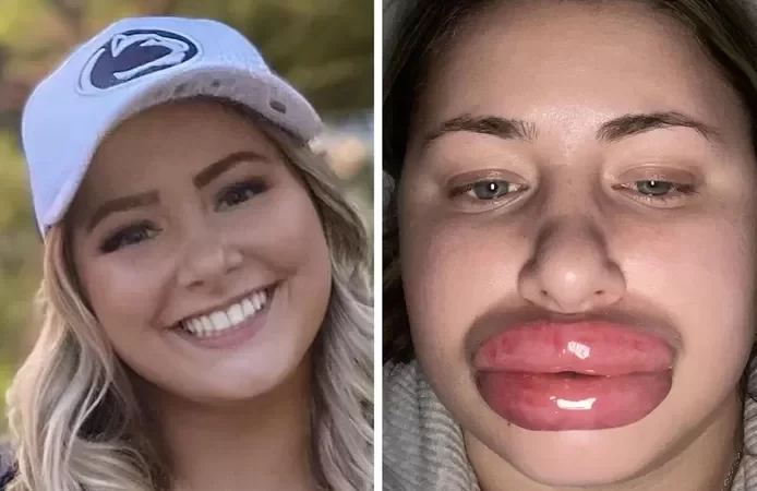 🇺🇸 “Je ressemble à une poupée gonflable”: une TikTokeuse partage son opération des lèvres