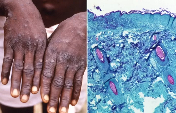 🦠 Qu’est-ce que la variole du singe? Est-elle mortelle? Une nouvelle crise sanitaire mondiale est-elle possible? Toutes les réponses à vos questions