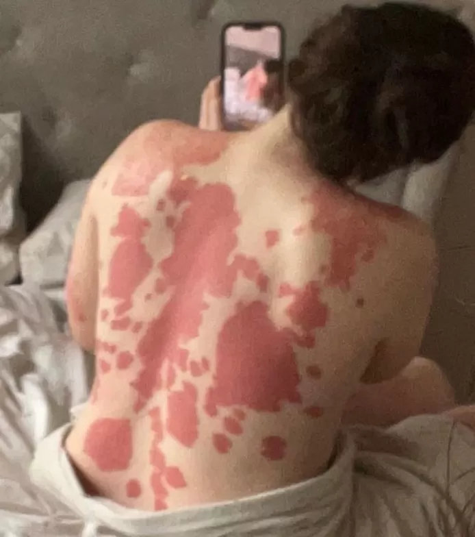 🇬🇧 Elle se réveille avec des taches rouges sur le corps et découvre qu’elle est atteinte d’une maladie rare 1 🇬🇧 Elle se réveille avec des taches rouges sur le corps et découvre qu’elle est atteinte d’une maladie rare