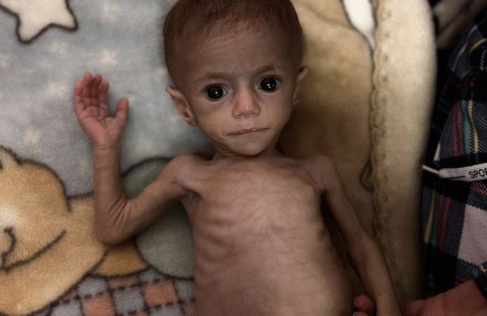 🇵🇸 Siwar, 6 mois, devient le symbole déchirant de la famine à Gaza